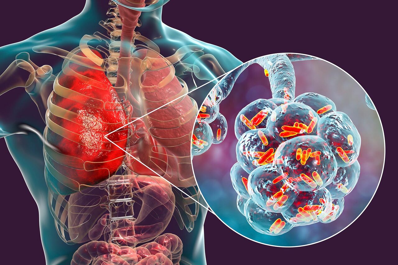 Legionnaire's Disease | Halton Housing